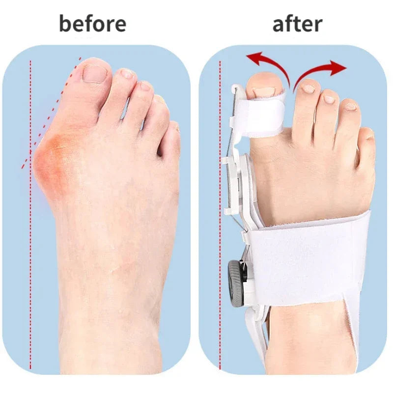 SoleMate™ Bunion Fix